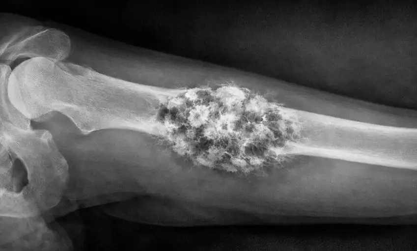 Luusyöpä reisiluussa – oireet, hoito ja ennuste kattavasti selitettynä