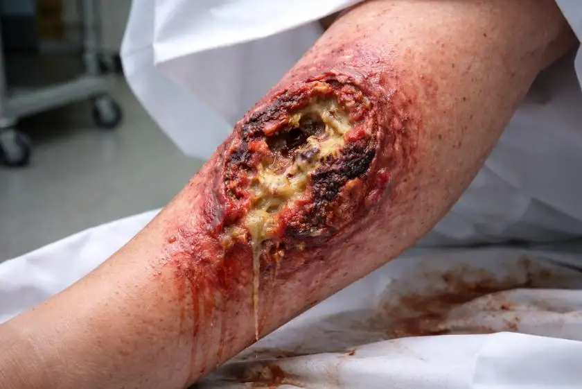 Luusyöpä sääressä – Oireet, diagnosointi, hoito ja ennuste