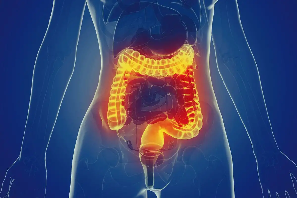 Paksusuolen syöpä oireet – varhaiset merkit, diagnosointi ja hoito