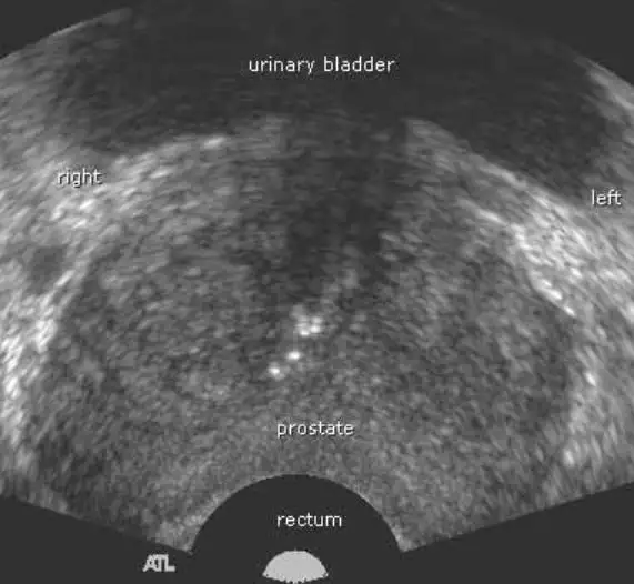Voiko eturauhassyöpä näkyä ultraäänessä? Kattava opas diagnostiikkaan ja tutkimusmenetelmiin